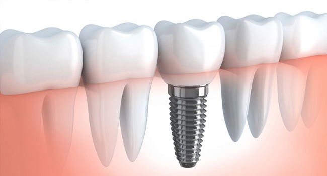 Impianto dentale