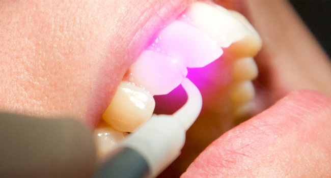 Laser terapia dentale nello studio dentistico